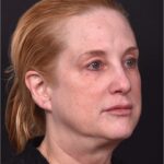 Lip lift best expert near me Atlanta collagen results before and after scarless permanent