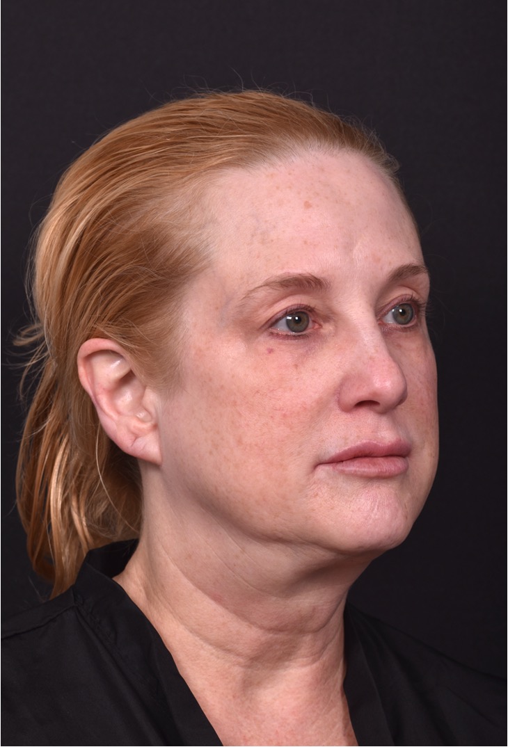 Lip lift best expert near me Atlanta collagen results before and after scarless permanent
