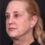 Lip lift best expert near me Atlanta collagen results before and after scarless permanent