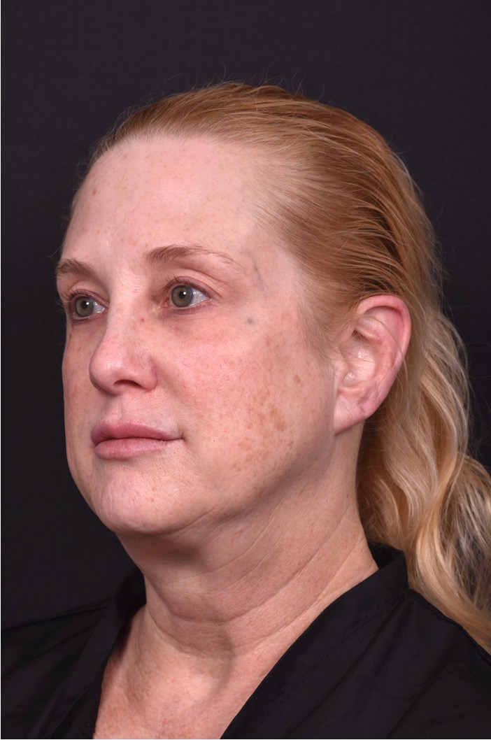 Lip lift best expert near me Atlanta collagen results before and after scarless permanent