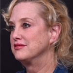 Lip lift best expert near me Atlanta collagen results before and after scarless permanent