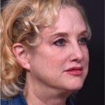 Lip lift best expert near me Atlanta collagen results before and after scarless permanent