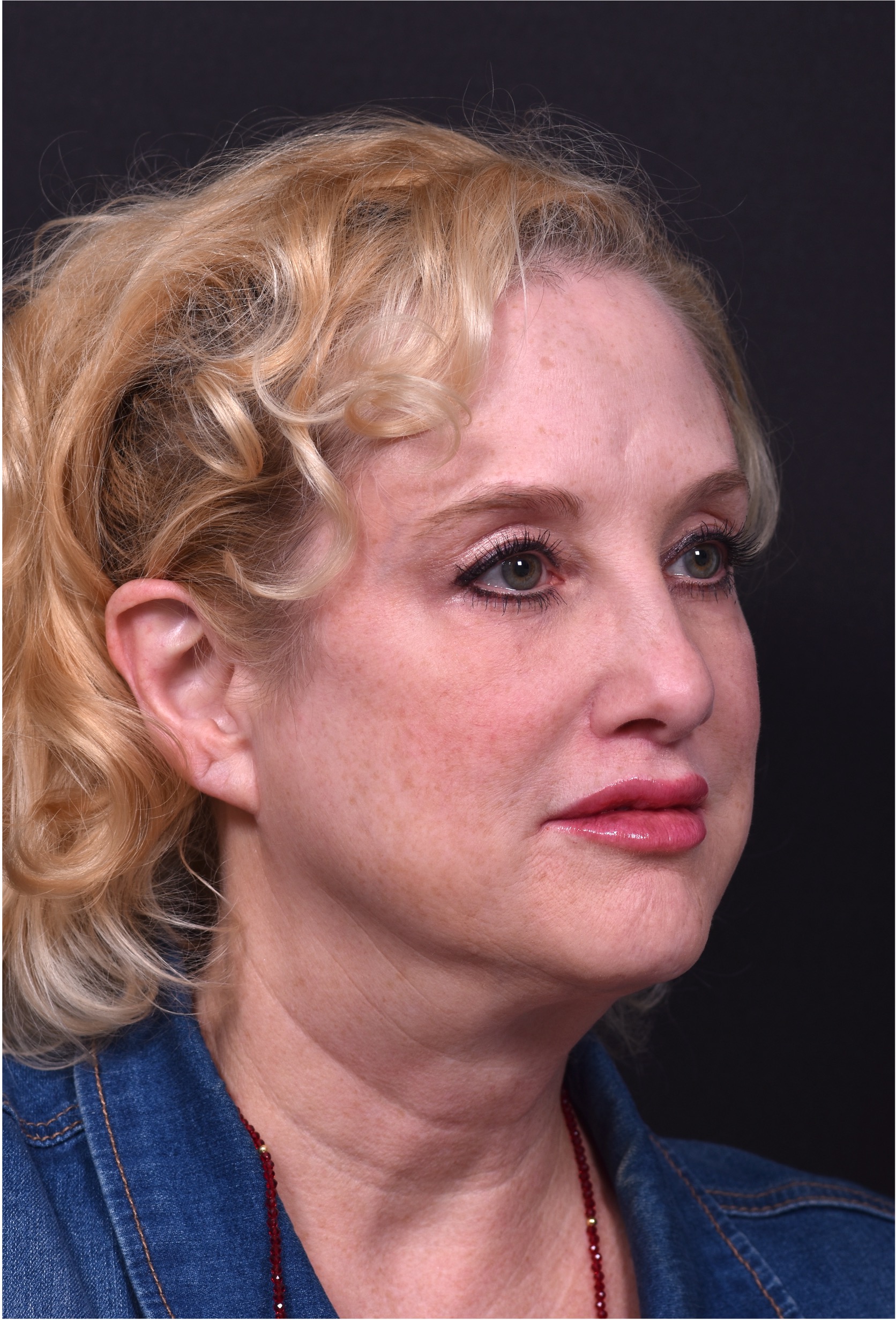 Lip lift best expert near me Atlanta collagen results before and after scarless permanent