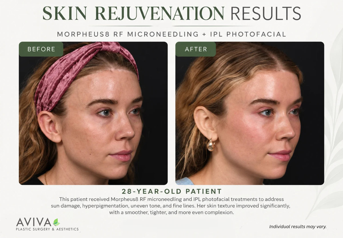 Morpheus8 RF microneedling and IPL photofacial before and after results at Aviva Plastic Surgery Atlanta
